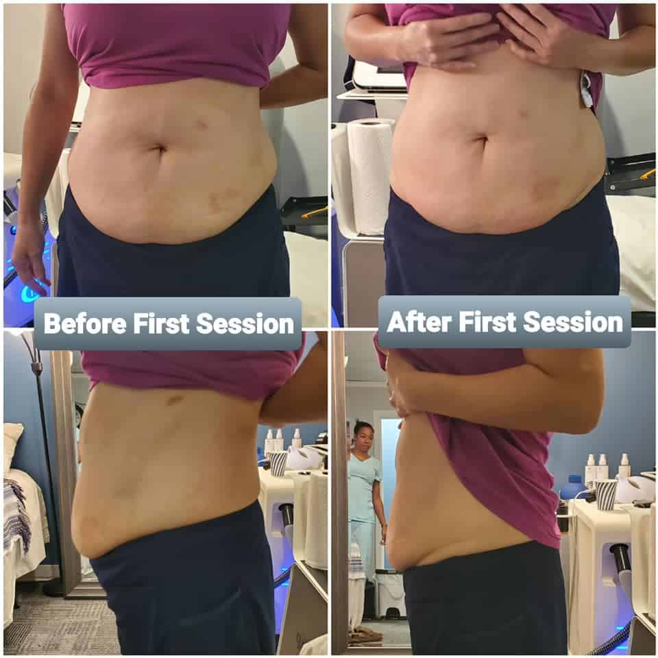 CryoSculpting client result Transform Me NC