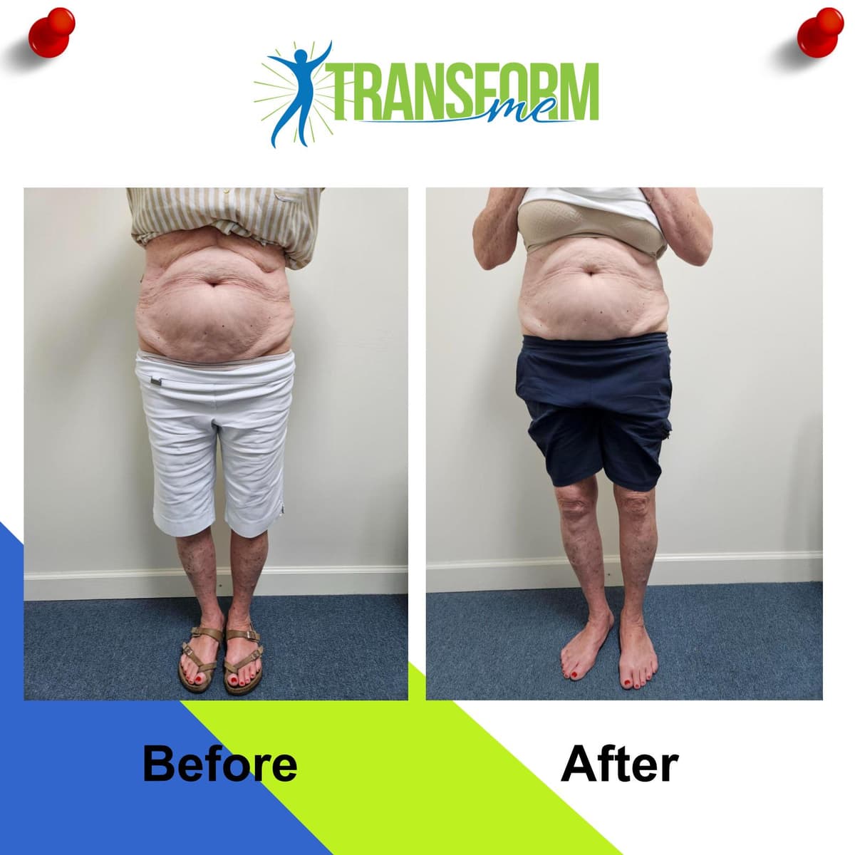 Body toning before and after front view June 2025
