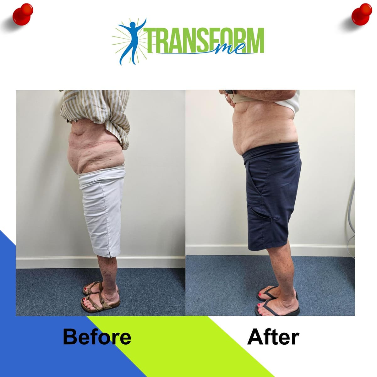 Body toning before and after side view July 2025