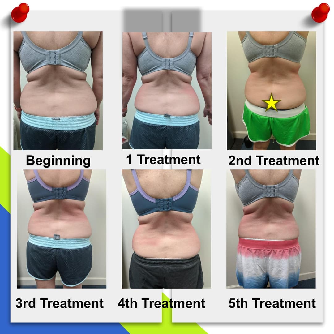 CryoSculpting before and after — back view after 5 treatments