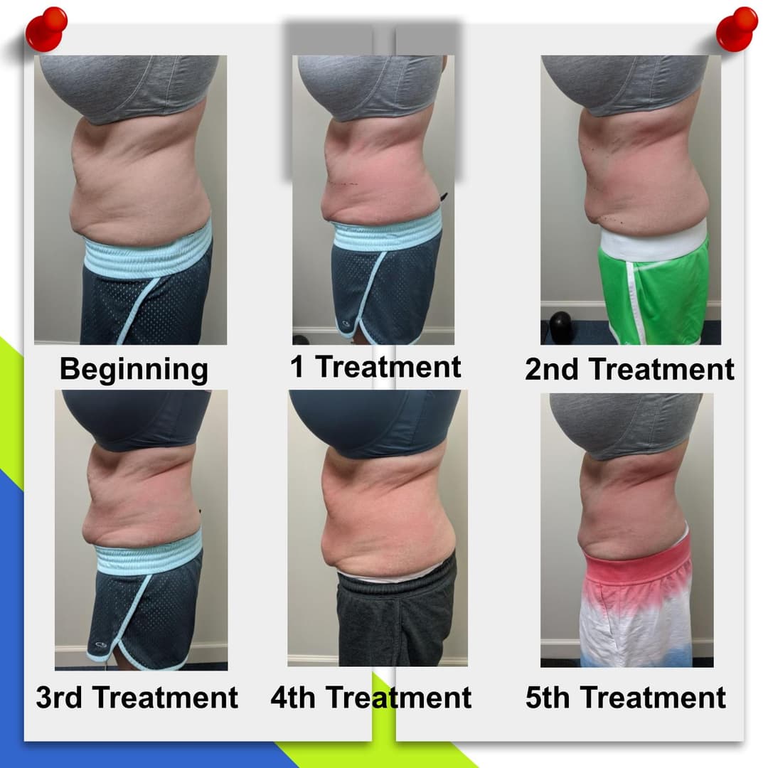 CryoSculpting before and after — side view after 5 treatments