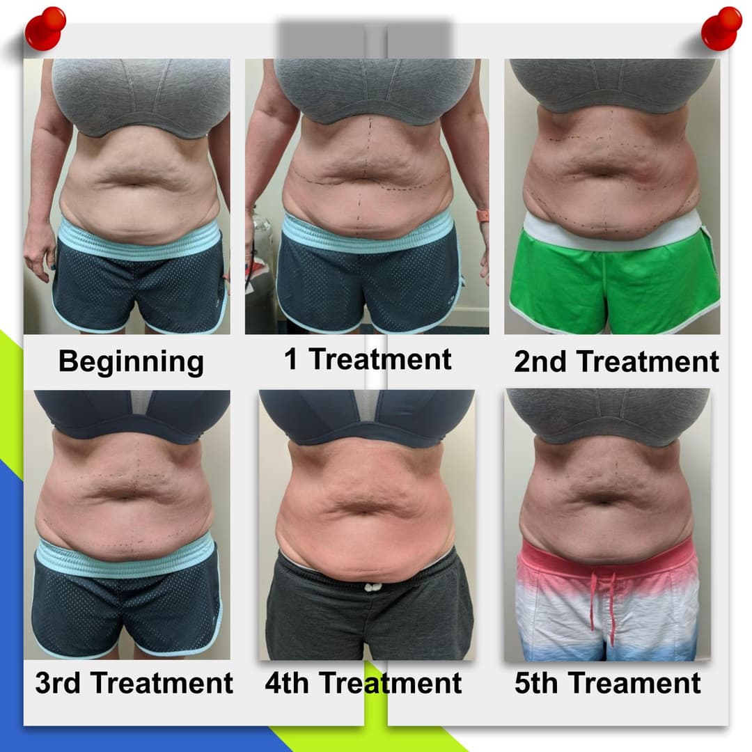 CryoSculpting before and after — front view after 5 treatments
