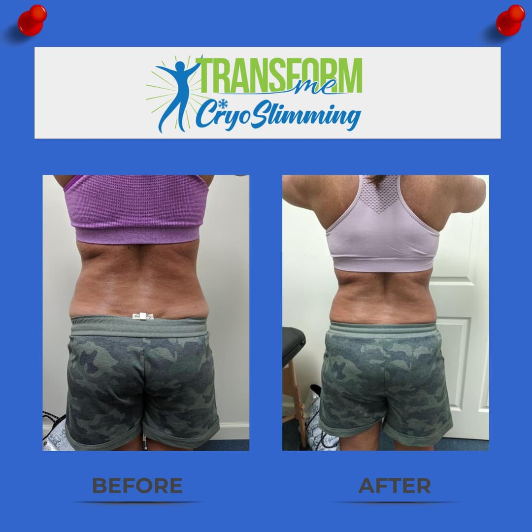 CryoSculpting before and after — back view after 3 treatments