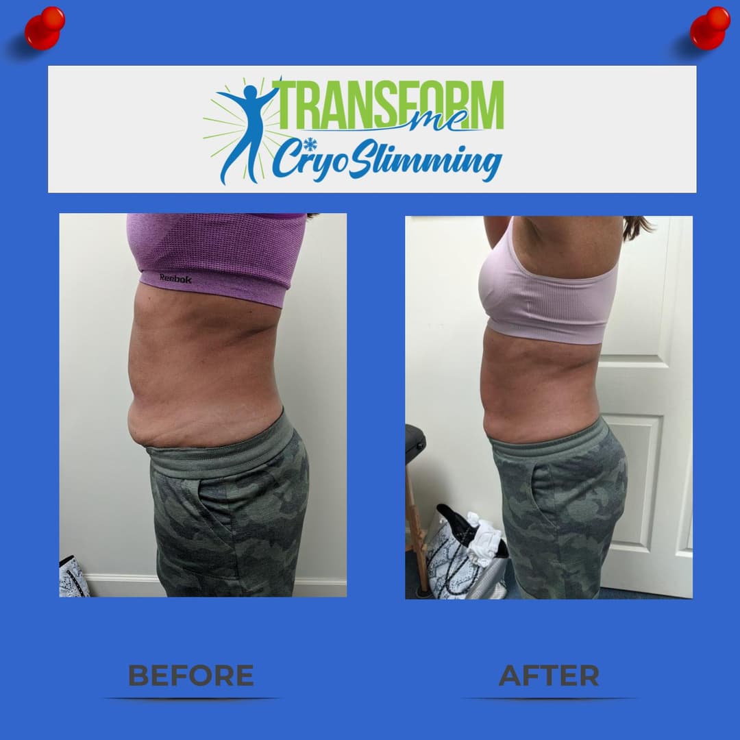 CryoSculpting before and after — side view after 3 treatments