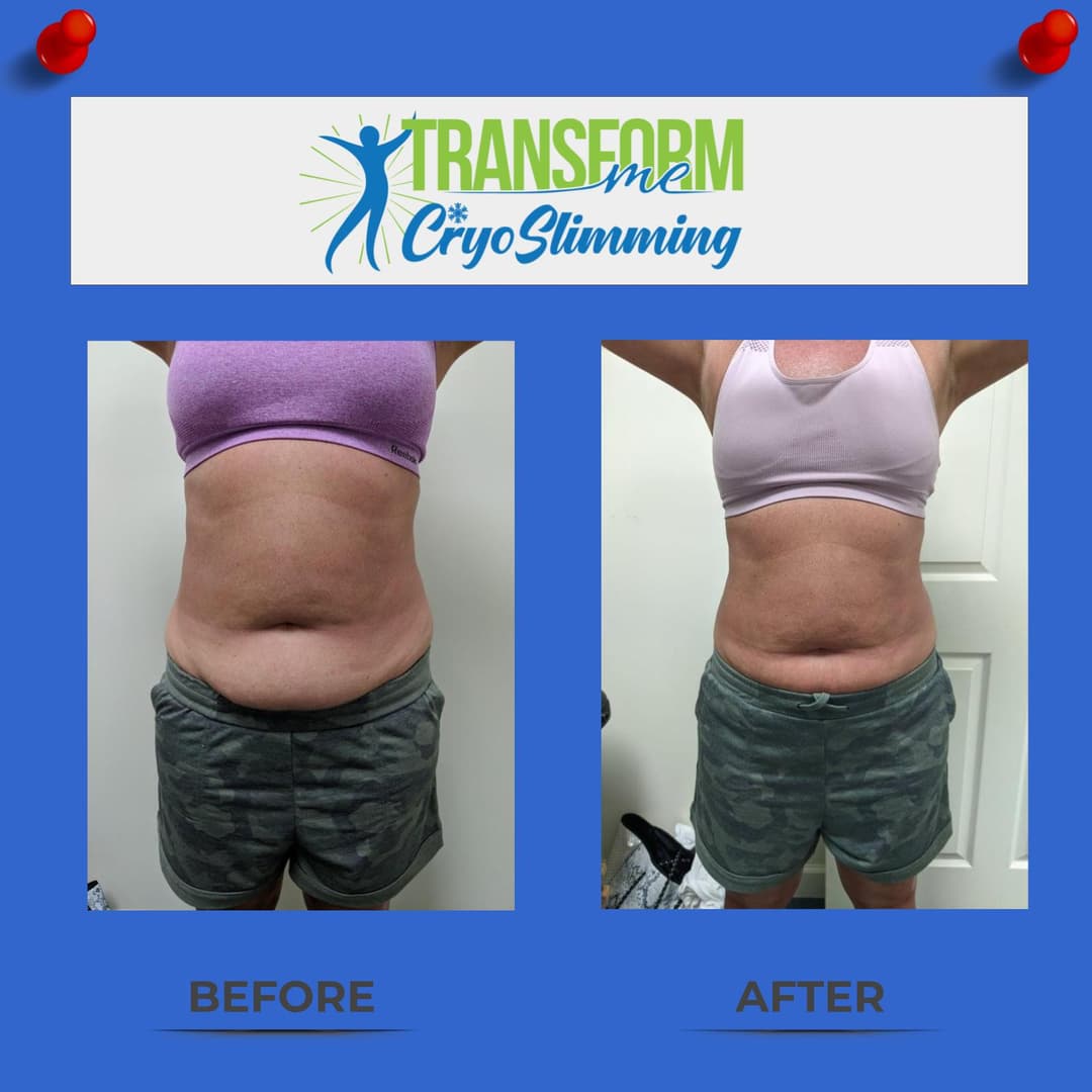 CryoSculpting before and after — front view after 3 treatments