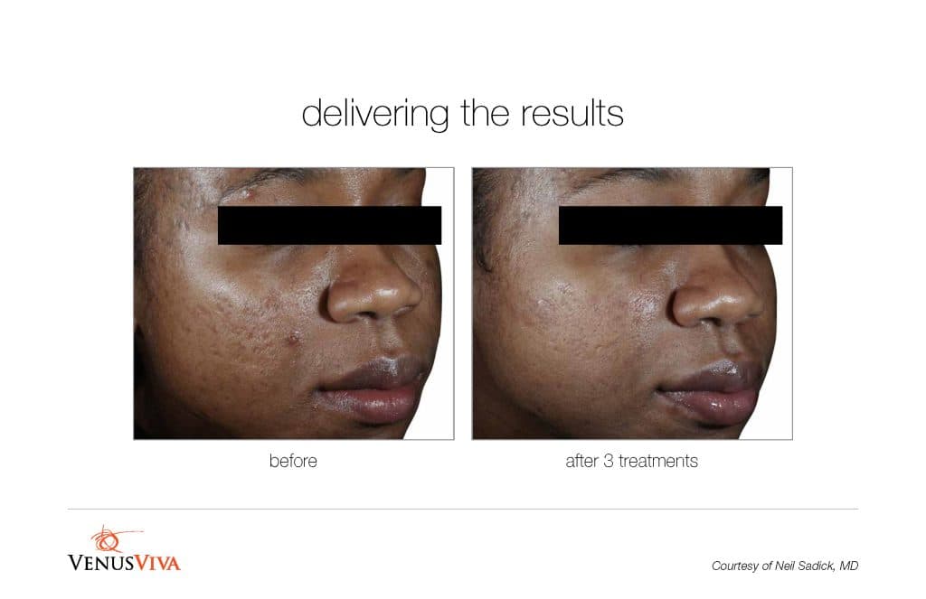 Venus Viva before and after skin resurfacing results